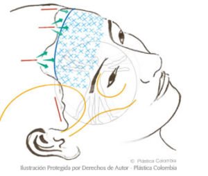 estiramiento de la frente bogota