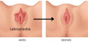 labioplastia bogota