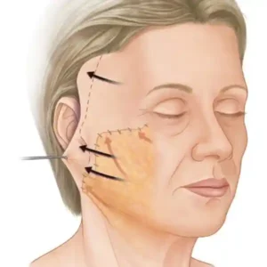 Ritidoplastia bogota
