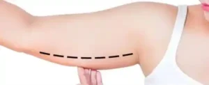 braquioplastia bogota