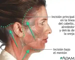 lifting facial bogota