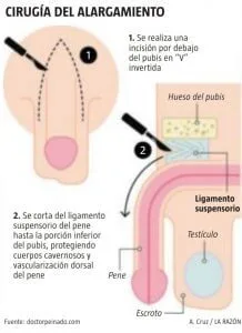 alargamiento de pene bogota